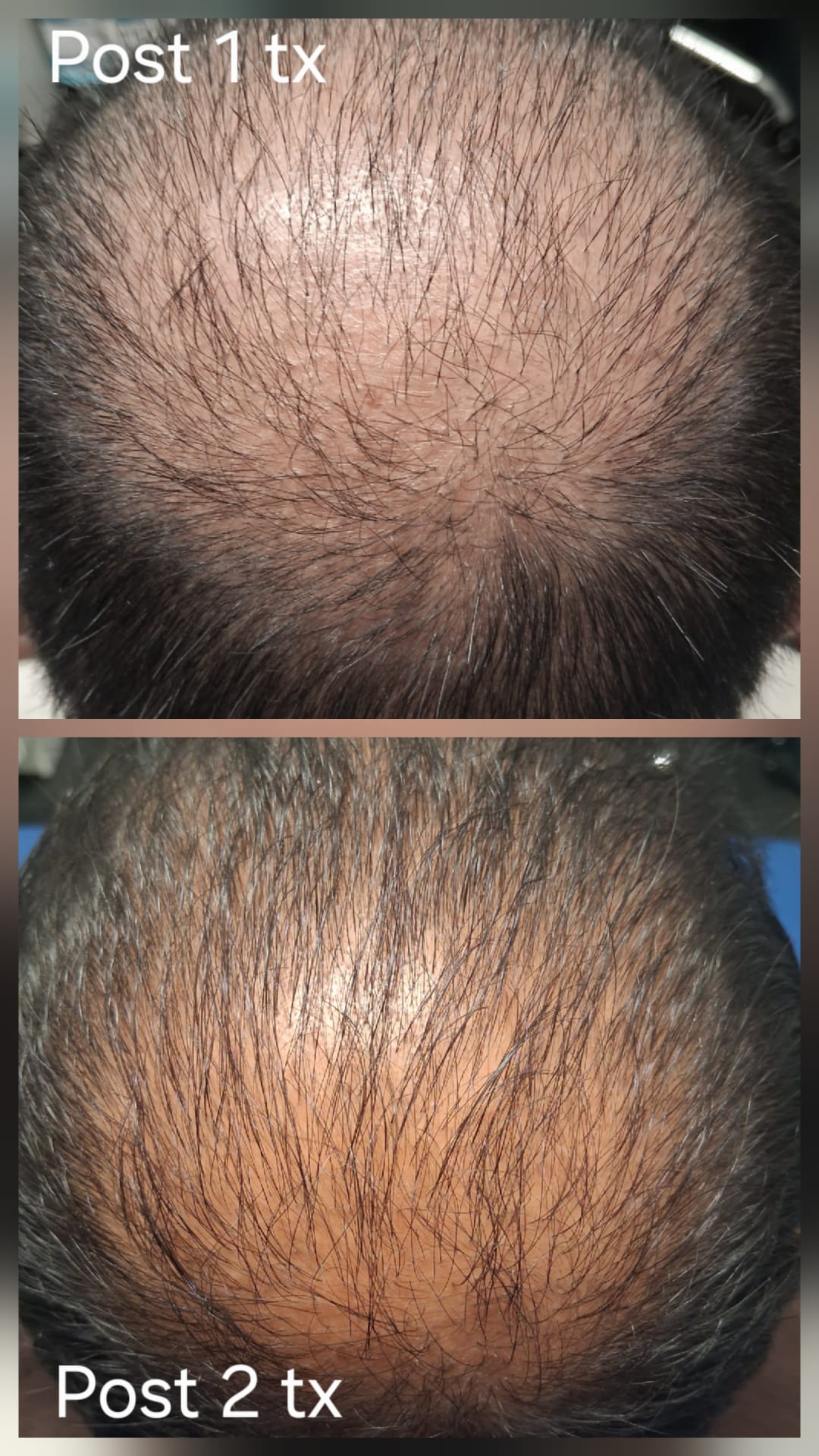 Hair restoration result